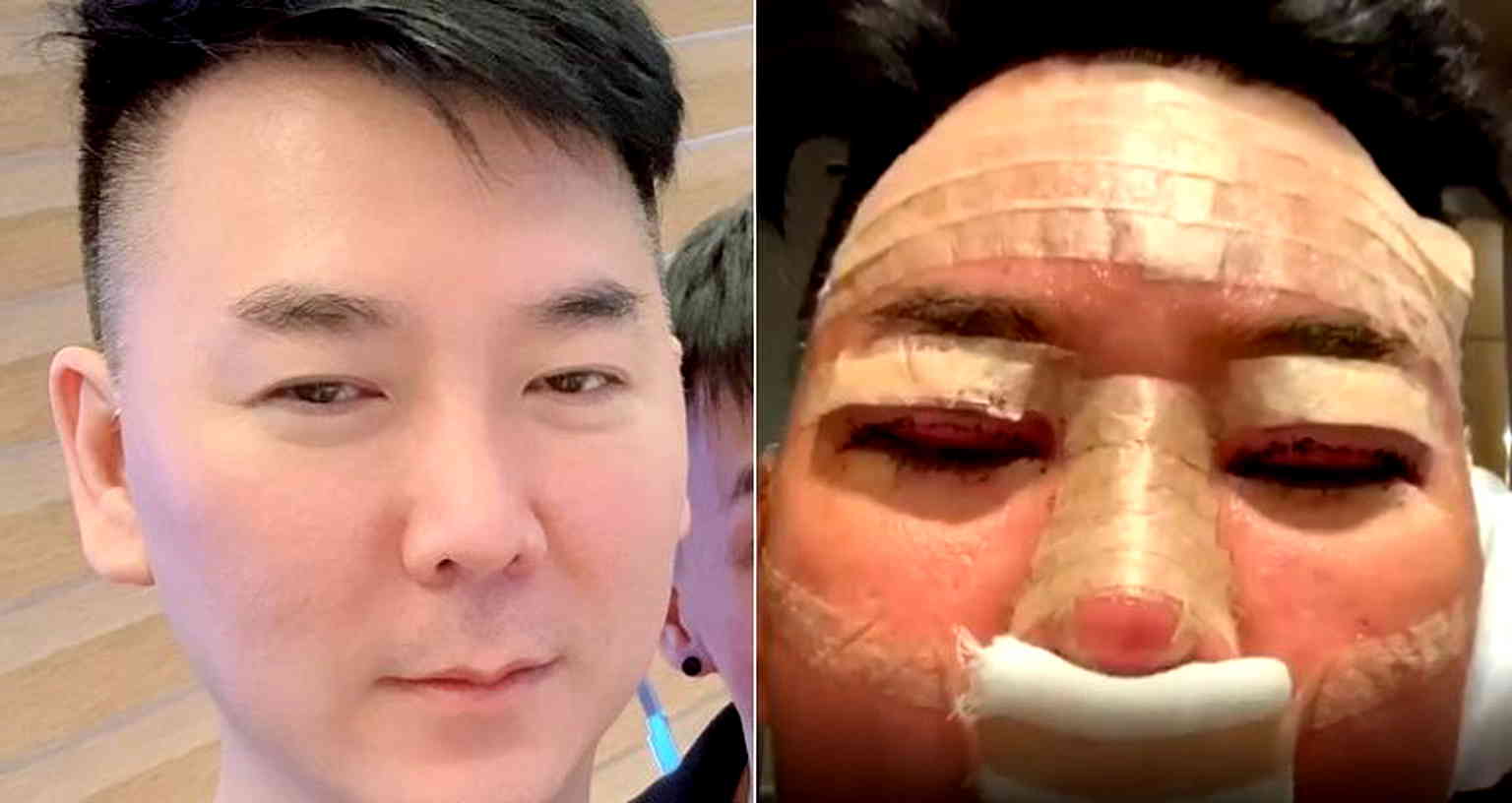 Celebrity in Singapore Plans to Sue South Korean Clinic for Botched Plastic Surgery