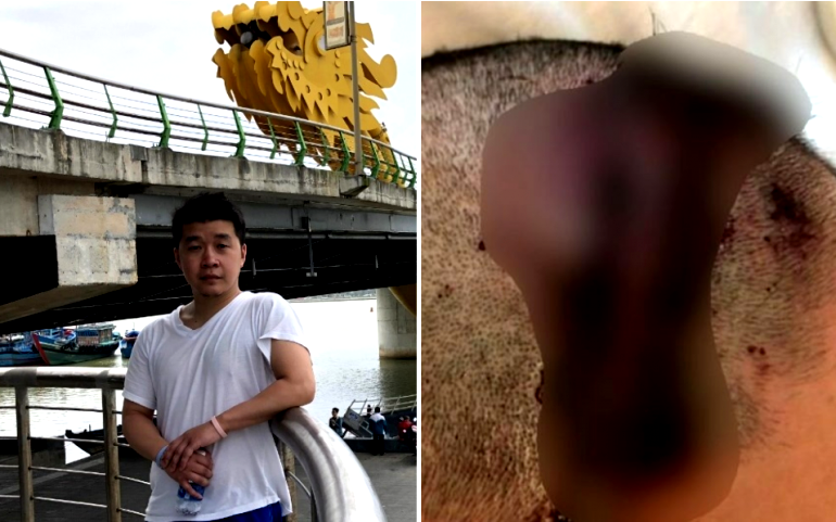 Man Left with F‌ract‌ur‌ed S‌kull After Being A‌‌s‌sa‌‌u‌lt‌e‌‌‌d by 6 Men On His Way to Work