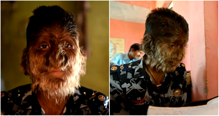 Indian Teen’s Rare Condition Lands Him the Name ‘Werewolf Boy’