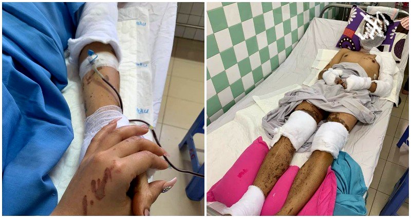 Canadian Couple Suffers Horrific Acid Attack While on Vacation in Vietnam