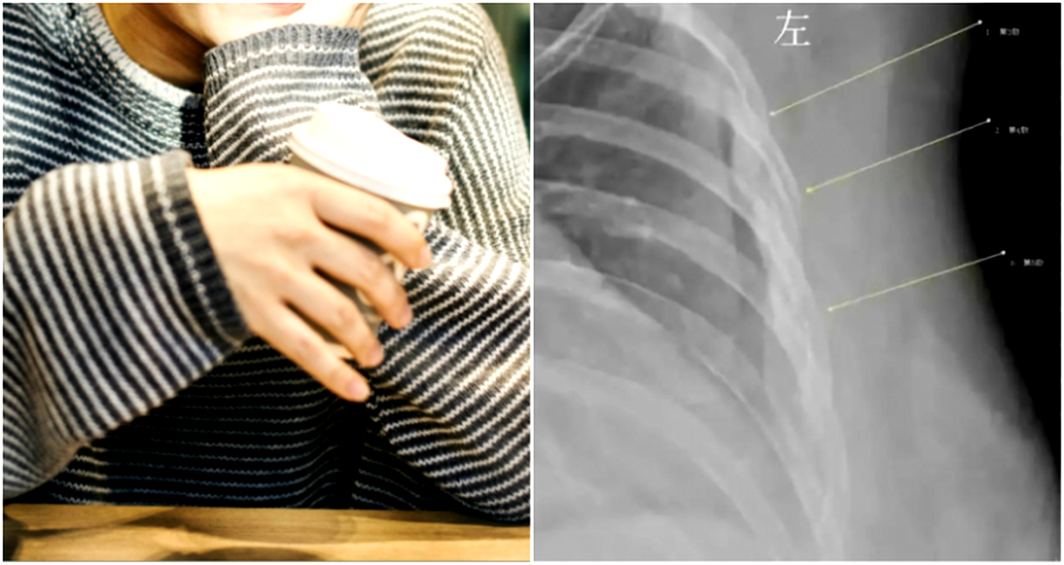 Chinese Woman Who Drank 10 CUPS of Coffee a Day for 7 Years Now Has the Bones of a Grandma