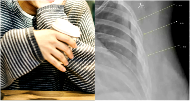 Chinese Woman Who Drank 10 CUPS of Coffee a Day for 7 Years Now Has the Bones of a Grandma