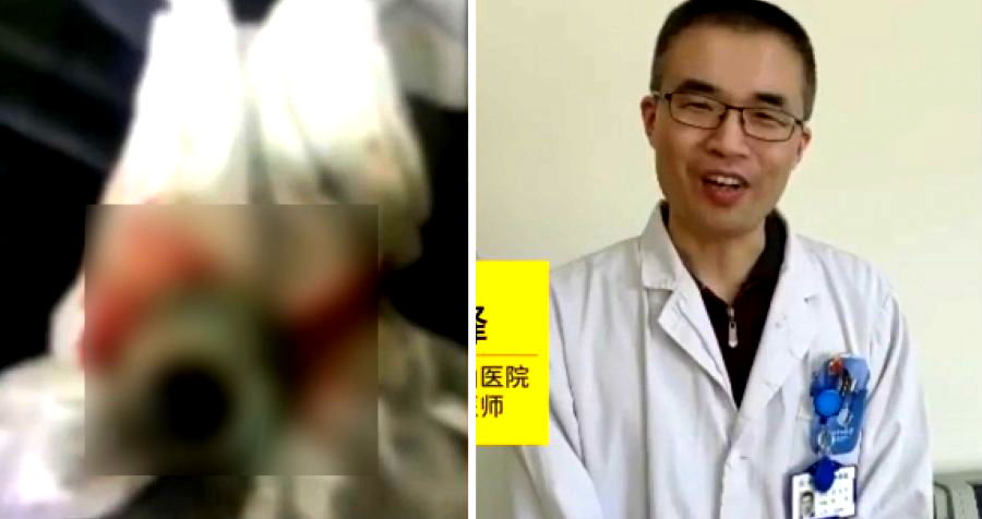 Chinese Man’s Eyeball Pops Out After Getting Too Drunk and Tripping