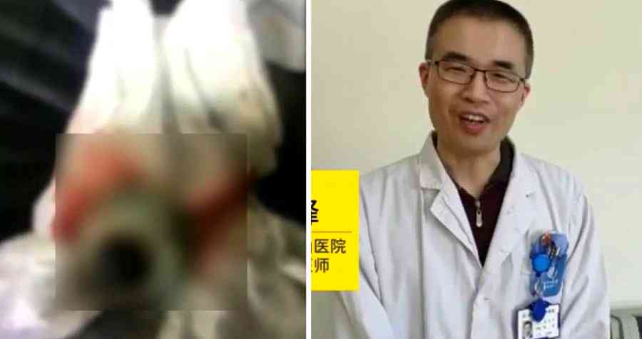 Chinese Man’s Eyeball Pops Out After Getting Too Drunk and Tripping
