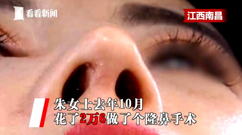 A woman in southeastern China allegedly sneezed out some cotton left over from a nose job that she had undergone half a year ago.