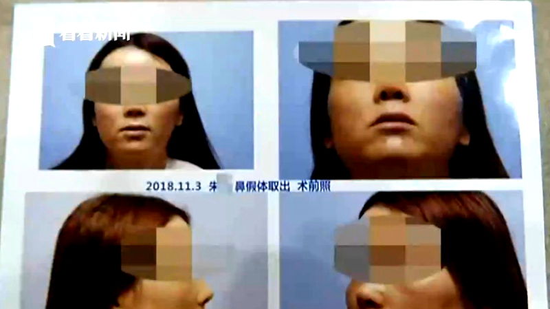 A woman in southeastern China allegedly sneezed out some cotton left over from a nose job that she had undergone half a year ago.