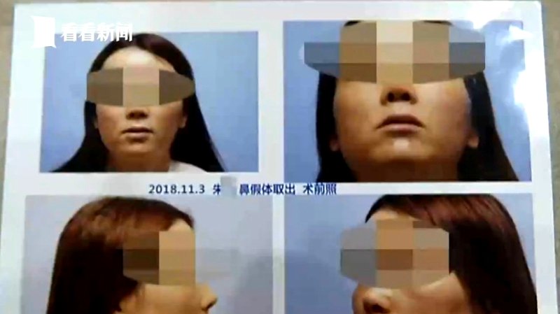 A woman in southeastern China allegedly sneezed out some cotton left over from a nose job that she had undergone half a year ago.