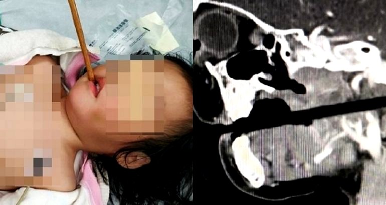 Toddler Running Around During Dinner Ends Up With a Chopstick in Her Skull