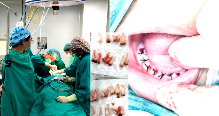 Boy Gets 18 Teeth Pulled Because He Refused to Brush After Drinking Milk