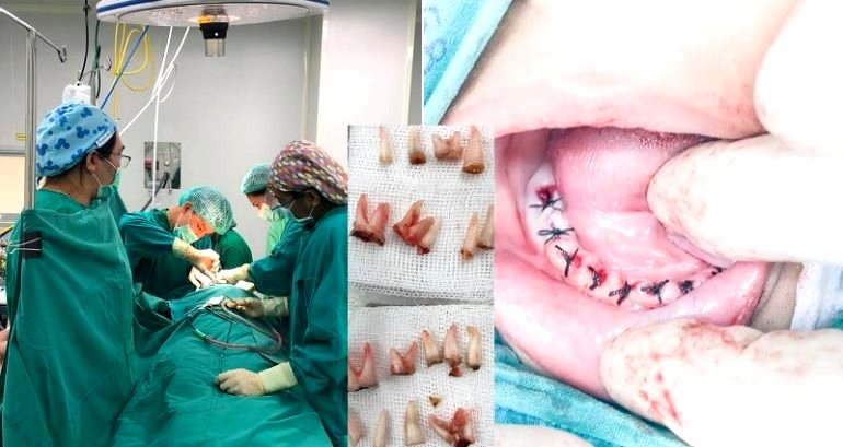 Boy Gets 18 Teeth Pulled Because He Refused to Brush After Drinking Milk