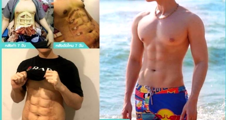 Thai Clinic Now Offers Plastic Surgery for 6-Pack Abs