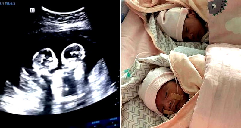 Ultra Sound Footage Shows Chinese Twin Sisters Literally Fighting Since They Were In The Womb 2490