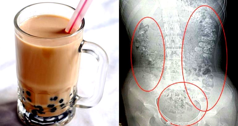 Undigested Boba Gives Girl Severe Constipation for 5 Days