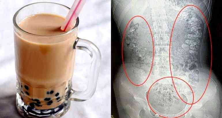Undigested Boba Gives Girl Severe Constipation for 5 Days