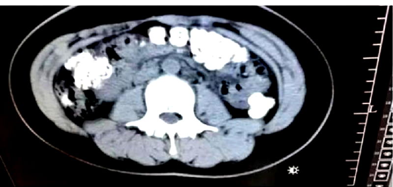 A 14-year-old girl from China was sent to the hospital after suffering from a bad case of constipation that lasted for five days.