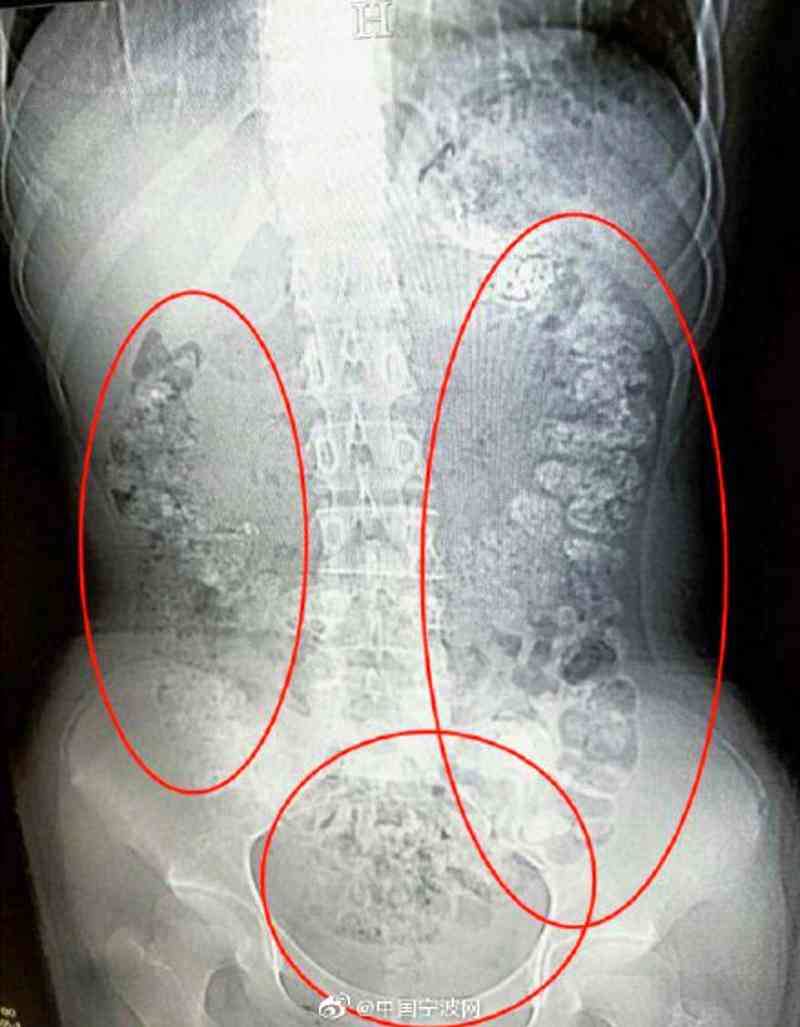 A 14-year-old girl from China was sent to the hospital after suffering from a bad case of constipation that lasted for five days.