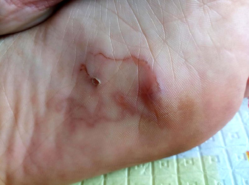 A Malaysian woman recently contracted a worm infection after walking bare feet on a beach in Port Dickson. 