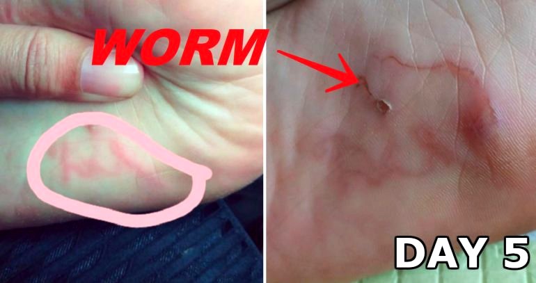 Woman Catches Terrifying Parasite in Her Foot Walking on Malaysian Beach