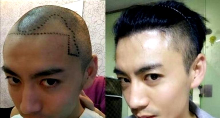 Hair Loss ‘Epidemic’ in China Fuels Surge in Millennial Hair Transplants