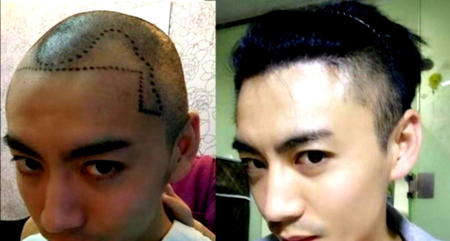 Hair Loss ‘Epidemic’ in China Fuels Surge in Millennial Hair Transplants