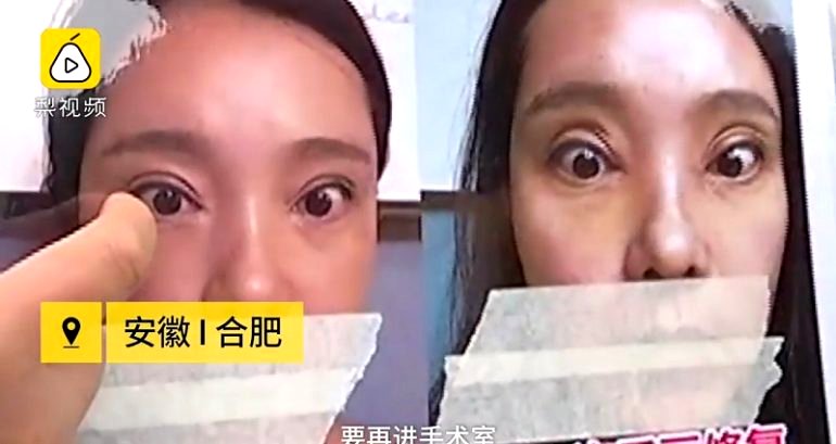 Woman Can’t Close Her Eyes After 2 Botched Double Eyelid Surgeries