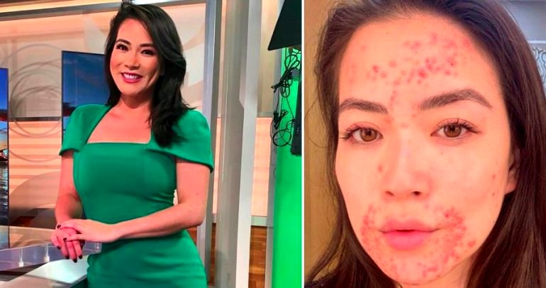 CBS Reporter Reveals Skin Condition That Has Covered Her Face for Months