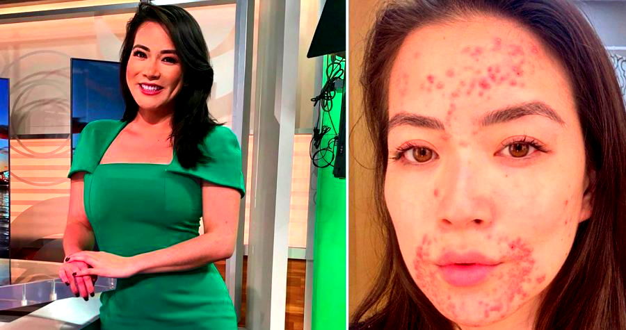 CBS Reporter Reveals Skin Condition That Has Covered Her Face for Months