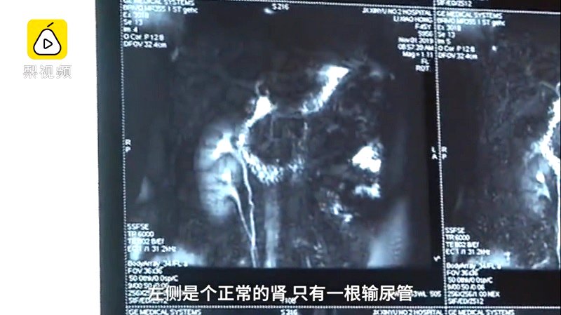 A woman from Xinyu, Jiangxi Province, China accidentally discovered she has three kidneys during a check-up with a doctor.