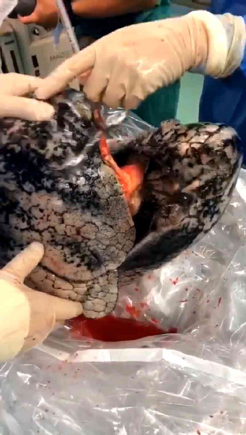A surgeon from China rejected a pair of donated blackened lungs that came from a heavy-smoker.