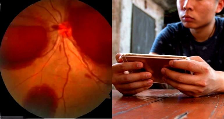 Man Loses Eyesight After Playing Mobile Games All Night