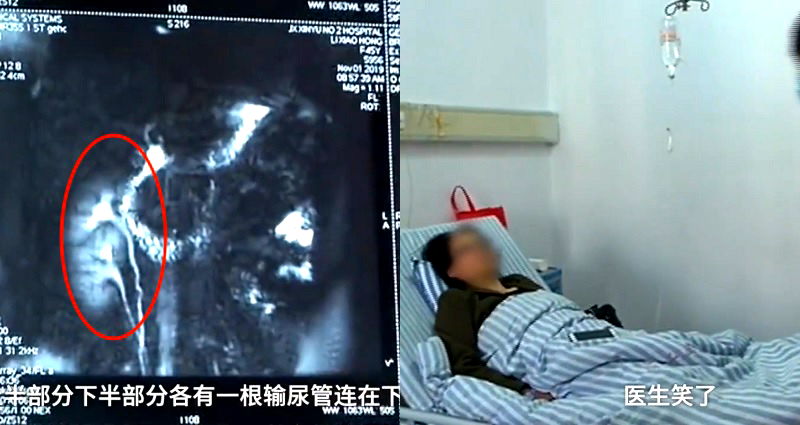 Chinese Woman to Donate Her Extra Kidney After Discovering She Has 3