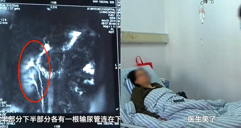 Chinese Woman to Donate Her Extra Kidney After Discovering She Has 3