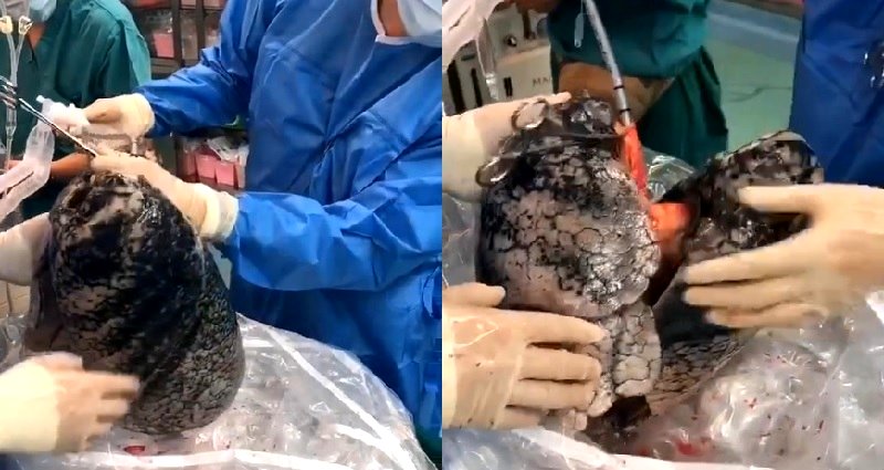 Chinese Doctors Given Chain Smoker’s Blackened Lungs for Organ Transplant