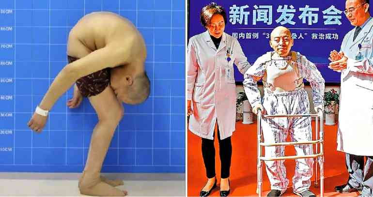 Chinese Man Who Spent 28 Years Bent Over Stands Up Straight for the First Time
