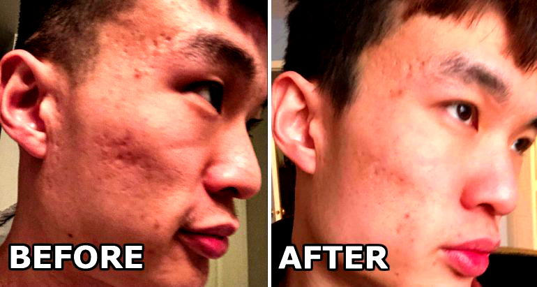 Esa Fung’s Shocking Results with Laser Therapy to Fight Acne Scars