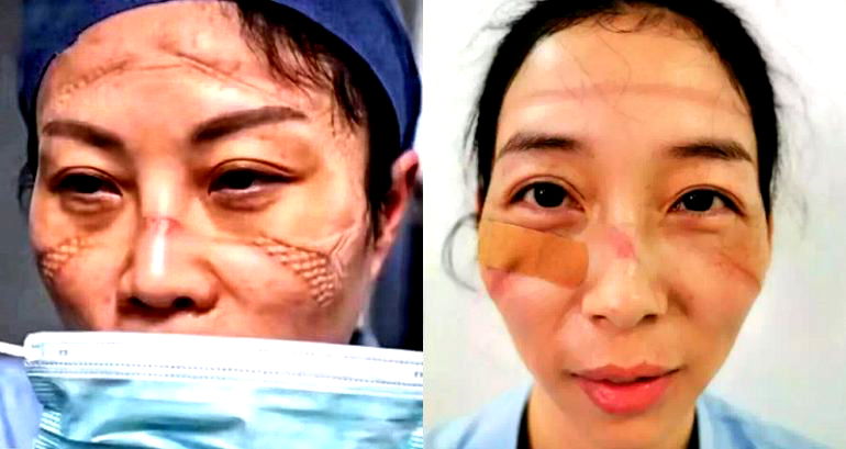 Chinese Nurses Show What Wearing a Face Mask for 10 Hours Looks Like