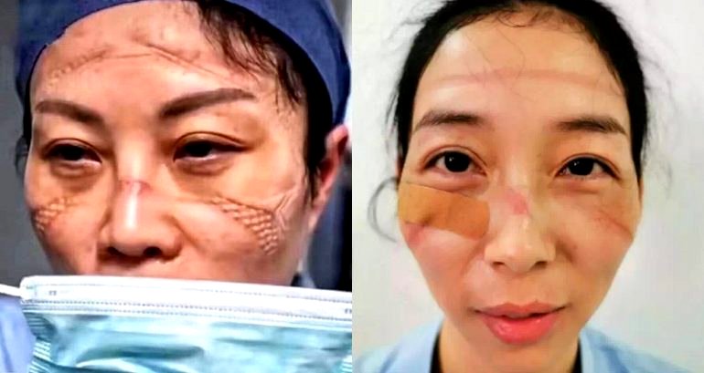 Chinese Nurses Show What Wearing a Face Mask for 10 Hours Looks Like
