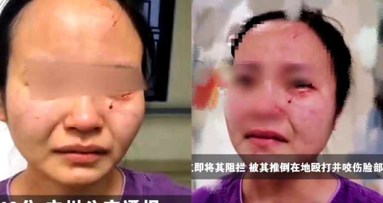 COVID-19 Patient Who Bit Nurse’s Face to Be Charged After Recovery in China