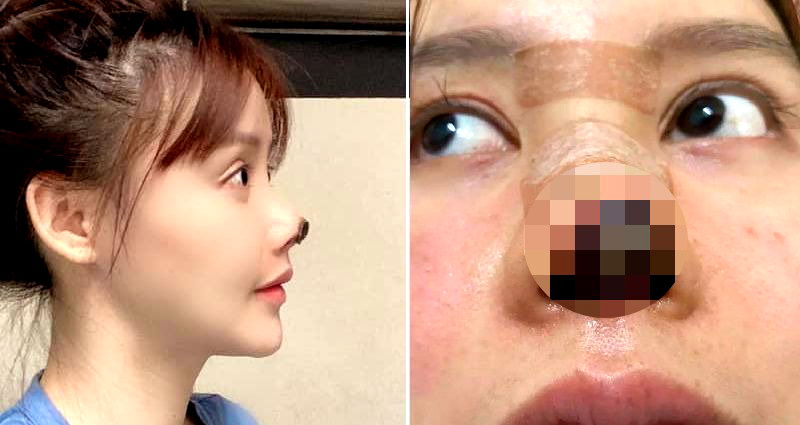 Chinese Actress Reveals ‘Rotting’ Nose from Cosmetic Surgery That Put Career on Hold