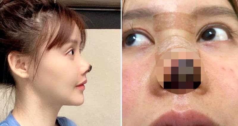 Chinese Actress Reveals ‘Rotting’ Nose from Cosmetic Surgery That Put Career on Hold