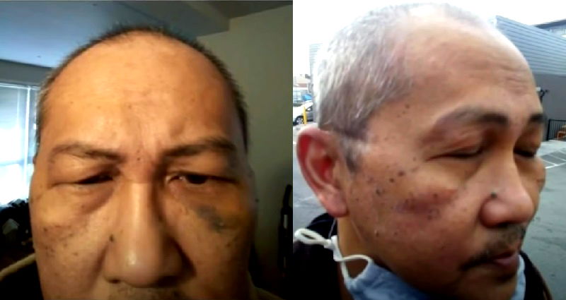 Asian American Army Veteran Beaten in Clear Hate Crime in SF