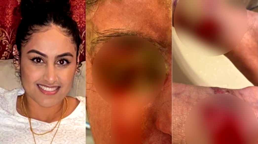 Pakistani College Student Survives ACID Attack Outside Her NY Home