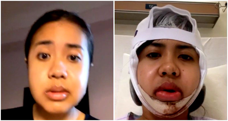 Singaporean student shares her $26,000 jaw surgery journey in viral TikTok video