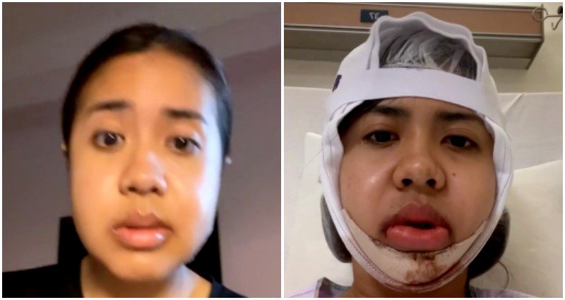 Singaporean student shares her $26,000 jaw surgery journey in viral TikTok video