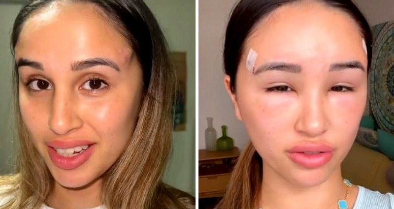Woman grows ‘horn-like’ protrusions after botched fox eye thread lift procedure