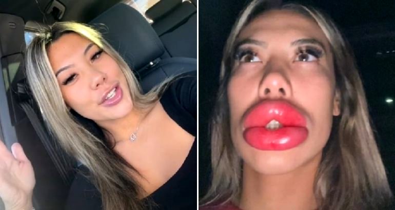 TikTok user goes viral over enormously swollen lips caused by discount lip filler procedure