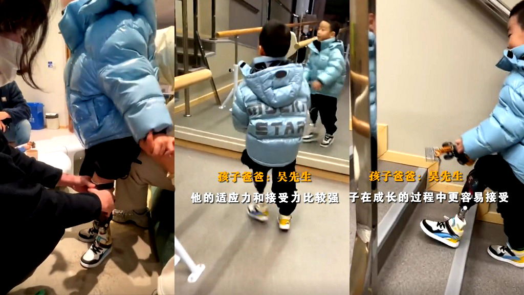 Chinese toddler receives custom prosthetic leg in heartwarming video