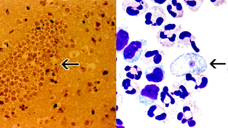 South Korean man dies due to ‘brain-eating amoeba’