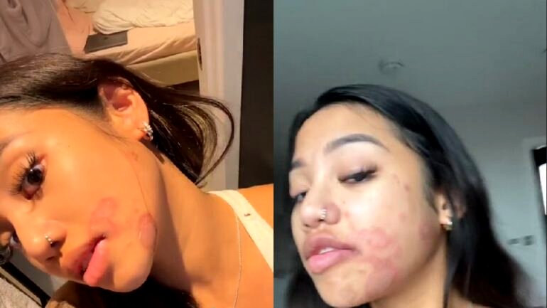 Beauty TikToker says she got ringworm after someone else used her makeup kit