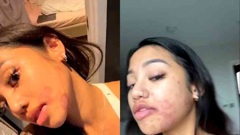 Beauty TikToker says she got ringworm after someone else used her makeup kit